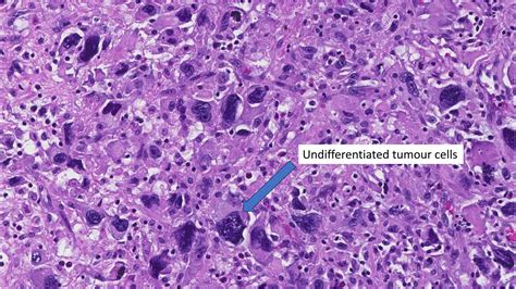 Undifferentiated Mypathologyreport Ca