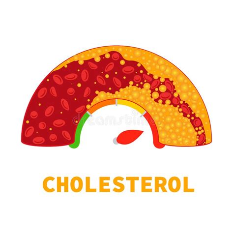 LDL Cholesterol Level Meter Gauge with Blood Vessel Diagram Stock Vector - Illustration of heart ...