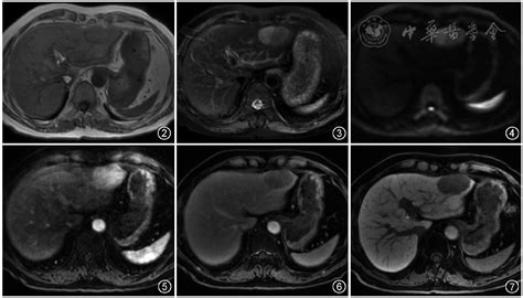 肝细胞癌的影像学诊断及鉴别诊断 中华放射学杂志