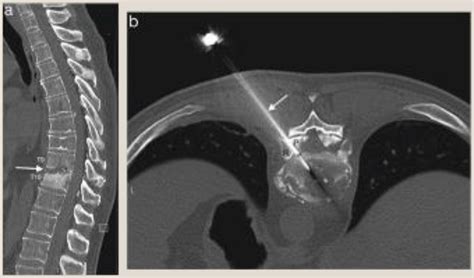 The Diagnosis And Management Of Discitis And Spinal Infection Surgery