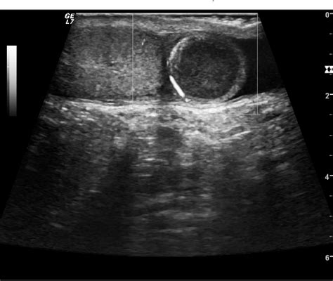 Epididymal Adenomatoid Tumor Semantic Scholar