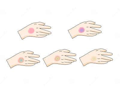 Bruise Stages Diagram Medical Science Stock Illustration - Illustration ...