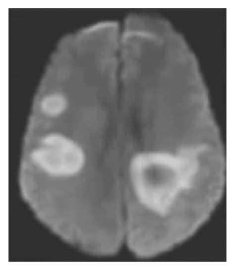 Partial MRI results of stroke patients. (a) TI; (b) T2; (c) T1C; and ...