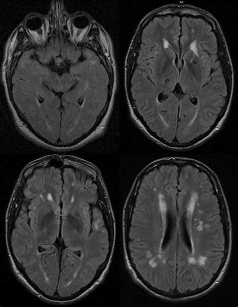 Case 1 T2 Flair Mri Of The Brain Imaging Shows Hyperintensities In Download Scientific