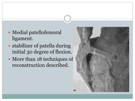 Medial patellofemoral ligament (MPFL) reconstruction | PPT