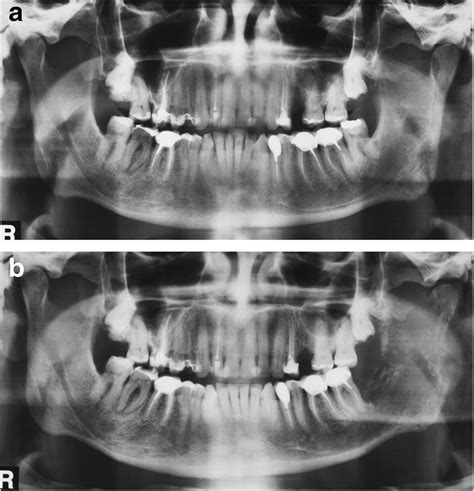 A Panoramic X Ray Showing Bone Changes In The Left Ramus Of The