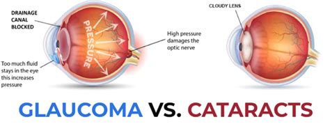 Cataract Vs Glaucoma Must Know Differences And Facts Public