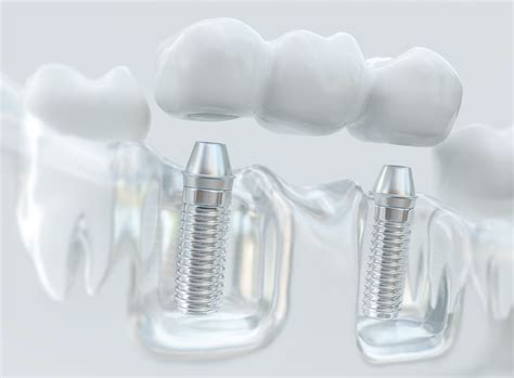 implant supported bridge - John White DDS