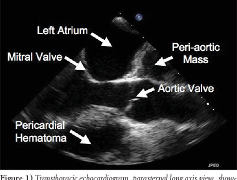 pericardial biopsy | Semantic Scholar