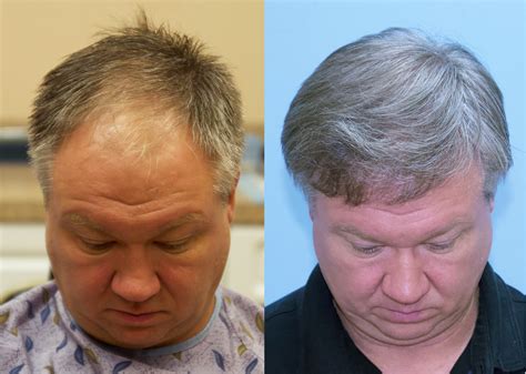 2500 FUE Frontal Hair Transplant Case Study - Carolina Hair Surgery