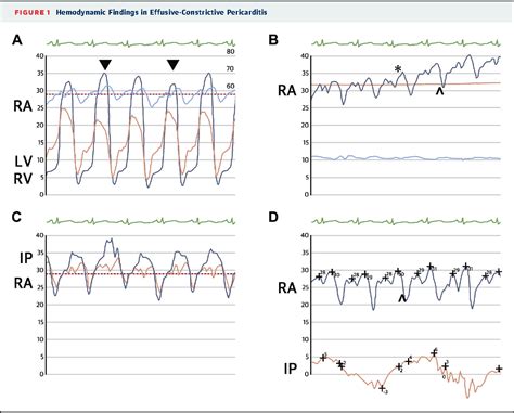 Figure From Hemodynamic Findings Of Effusive Constrictive