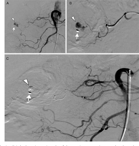 Figure 3 From Acute Intestinal Bleeding After Endoscopic Polypectomy