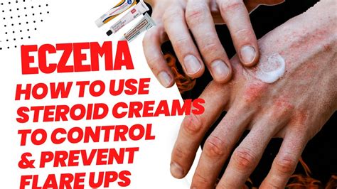 How To Treat Eczema And Prevent Flare Ups Safely With Steroid Creams