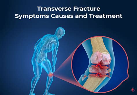 Transverse Fracture - Symptoms, Causes, and Treatment | ER of Mesquite 