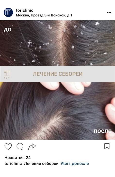 Лечение себореи, терапия при лечении сухой себореи цена в Москве