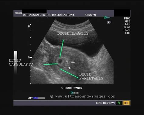 Double Decidual Sac Diagnostic Medical Sonography Obstetric