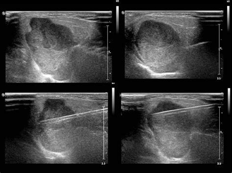 Figure 1 From Ultrasound Guided Salivary Gland Core Needle Biopsy The Road To Take Semantic