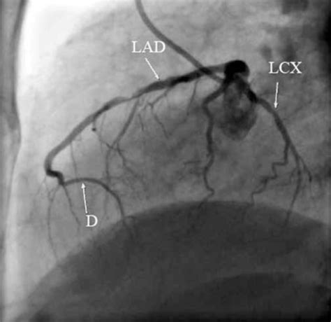 Selective Coronary Angiography At The Straight Lateral Open I