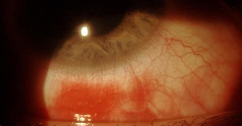 Sonoran Desert Eye Center: HEMORRHAGIC VIRAL CONJUNCTIVITIS