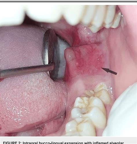 Figure 2 From Central Mucoepidermoid Carcinoma In The Mandible Mimicking Dentigerous Cyst A