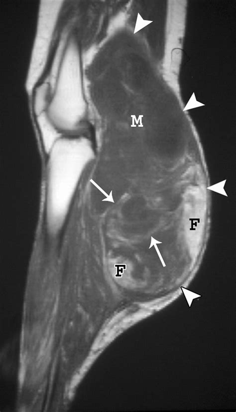 Imaging Of Musculoskeletal Liposarcoma With Radiologic Pathologic