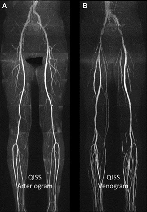 Noncontrast Magnetic Resonance Angiography For The Diagnosis Of