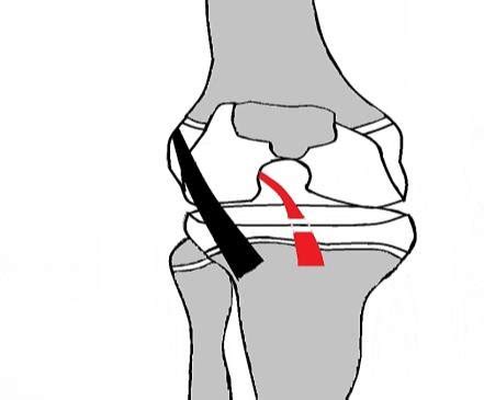 The Anterior Cruciate Ligament Acl Reconstruction In A Skeletally