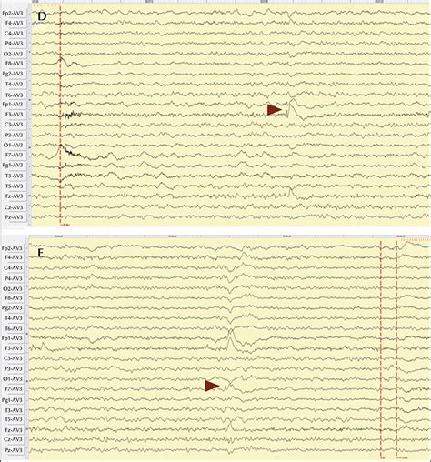 JLE Epileptic Disorders Leukoencephalopathy With Calcifications And