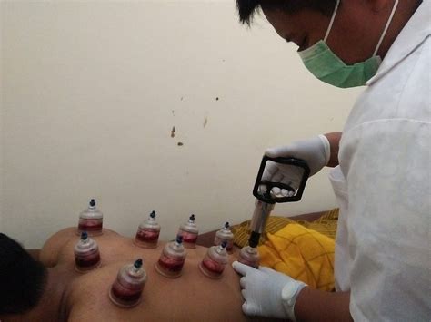 layanan bekam terapi bekam  pencegahan pengobatan  pemulihan