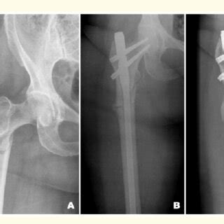 Case Radiographs A Preoperative B First Postoperative Day Of