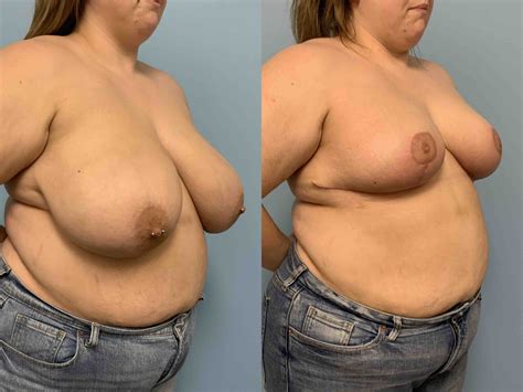 Breast Reduction Gallery Dr Paul Vanek