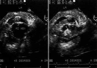 Intraoperative Multiplane Vs Biplane Transesophageal Echocardiography