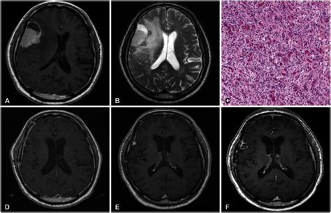 Clinical And Radiological Characteristics Of Angiomatous Meningiomas Pmc