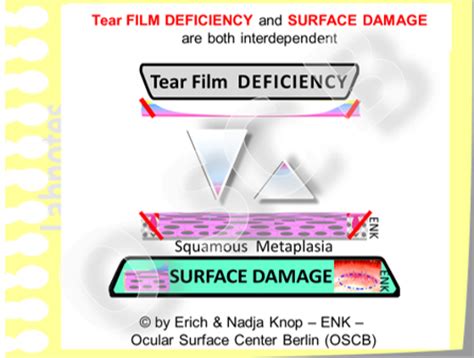 Overview How Dry Eye Gets Worse Ocular Surface Center Berlin