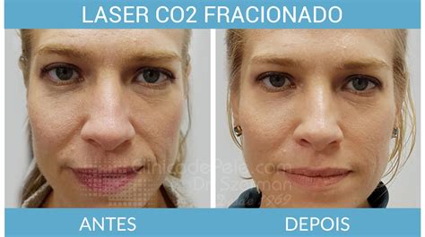 Laser De Co Fracionado Dr Szerman Dermatologia Desde No Rio