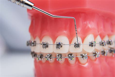 Orthodontics treatment - Everything to know about braces - Dental Dost