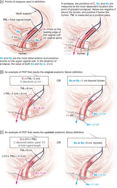 Pelvic Prolapse Surgery Complications