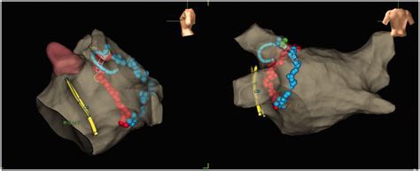 Electroanatomic Map After Ablation For Atrial Fibrillation In A Patient