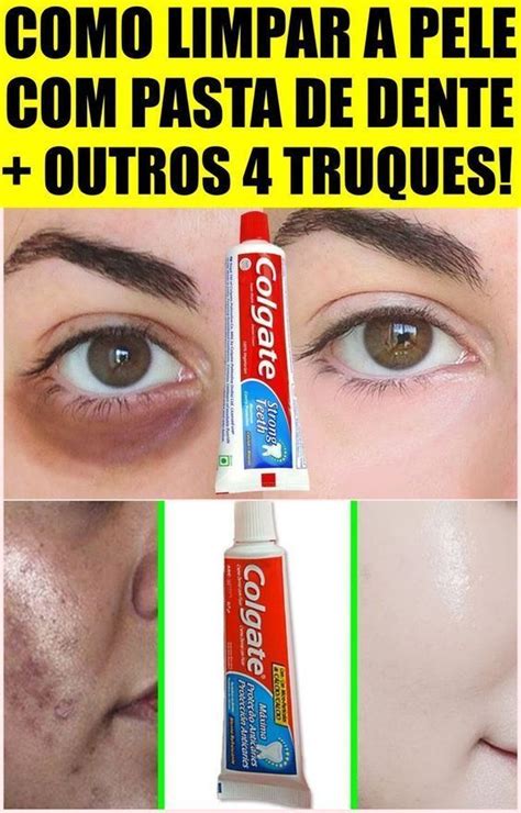 Creme Dental Tira Manchas Da Pele Veja Como Fazer Limpeza De Pele