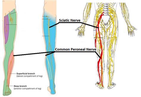 Afos For Foot Drop Foot Drop Exercises And Physical Therapy