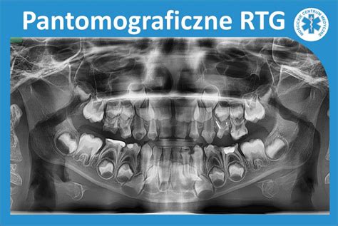 Pantomograficzne Rtg Dla Bardziej Precyzyjniej Diagnostyki Mo Cickie