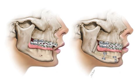 Fixation The Final Step Of Total Subapical Osteotomy Procedure With