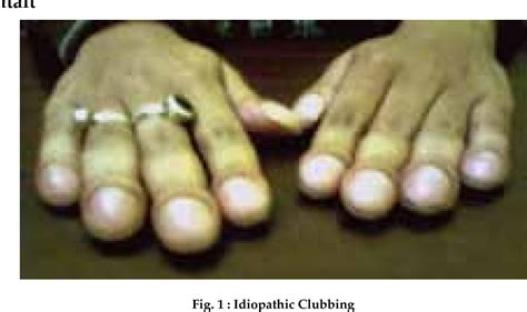 Figure 1 From Idiopathic Clubbing A Typical Presentation Semantic