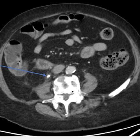 Axial View Of Contrasted Computed Tomography Of The Abdomen And Pelvis