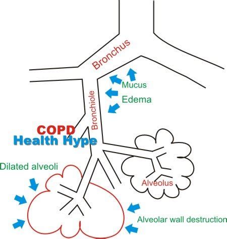 What is COPD? What Causes Chronic Obstructive Pulmonary Disease ...