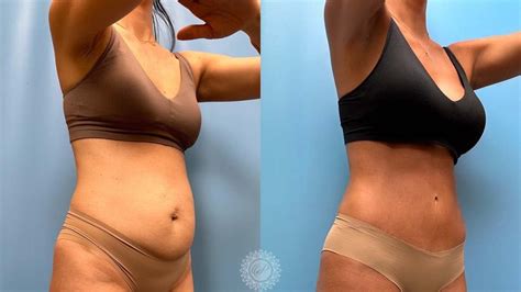 Tummy Tuck Chicago NW Indiana Costs Petrungaro Plastic Surgery