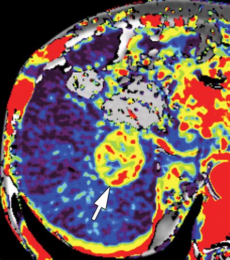 Quantitative Ct Color Mapping Of The Arterial Enhancement Fraction Of