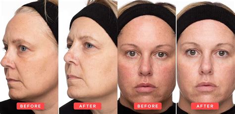 Exponent Beauty Vitamin C Serum Before And After Images Exponent