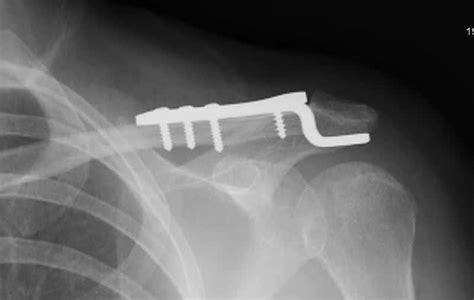 Managing Mid Shaft Clavicle Fracture A Comprehensive Guide