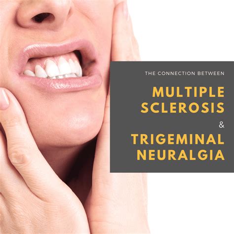 The Connection Between Multiple Sclerosis And Trigeminal Neuralgia